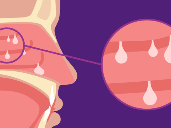 Los pólipos nasales y la inflamación tipo 2