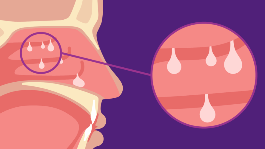 Los pólipos nasales y la inflamación tipo 2