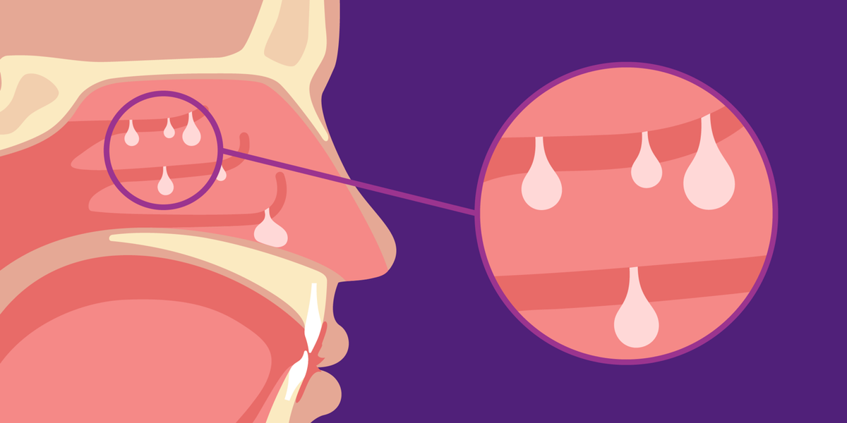 Nasal Polyps and Sort 2 Irritation