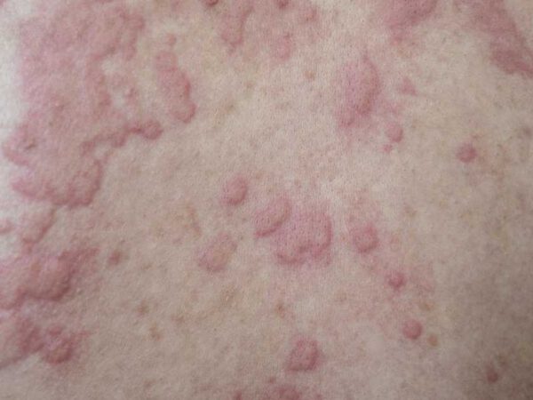 Continual Spontaneous Urticaria 101 – HealthyWomen