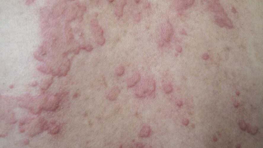 Continual Spontaneous Urticaria 101 – HealthyWomen