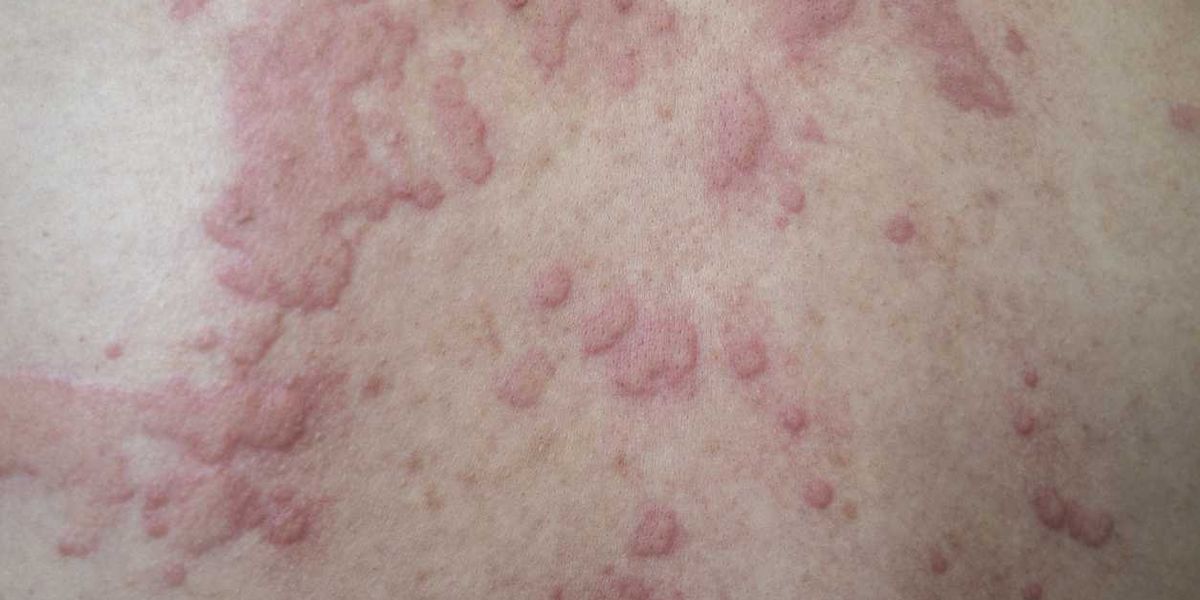 Continual Spontaneous Urticaria 101 – HealthyWomen