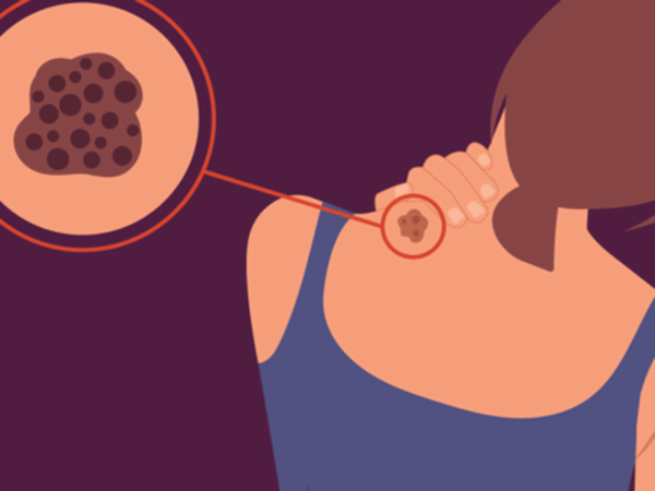 Kinds of Melanoma – HealthyWomen