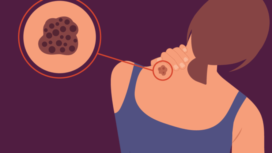 Kinds of Melanoma – HealthyWomen