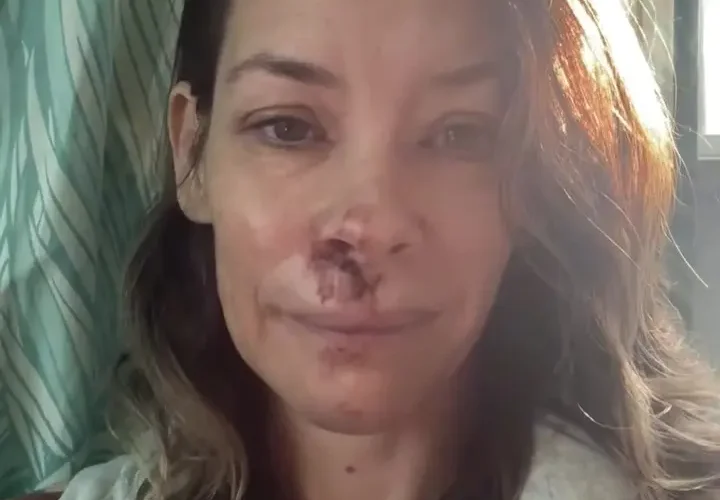 Evangeline Lilly Well being Replace: TBI Prognosis and Restoration