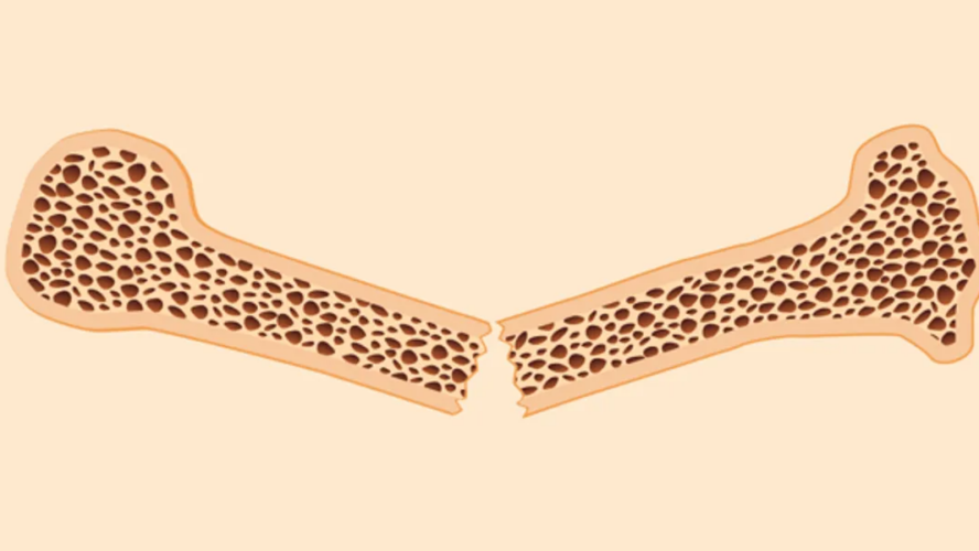 Osteoporosis Remedies – HealthyWomen