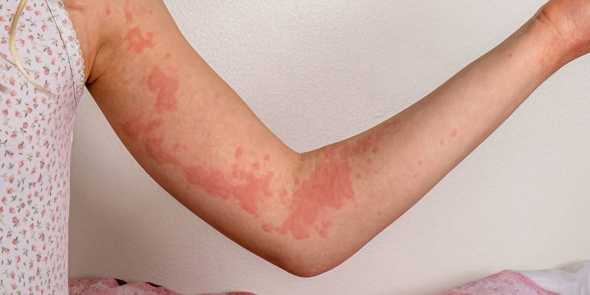 Managing continual spontaneous urticaria – HealthyWomen