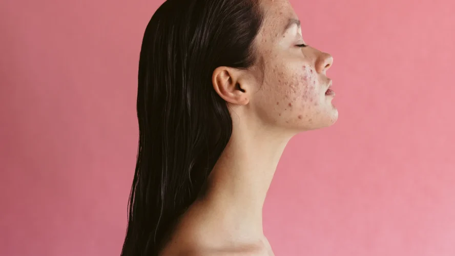 Being pregnant-Protected Pimples Remedies That Truly Work