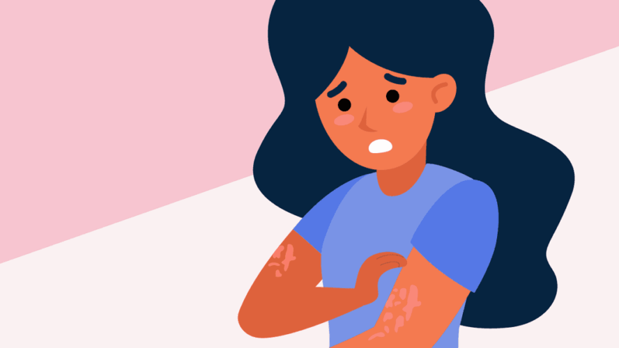 Information About Persistent Spontaneous Urticaria