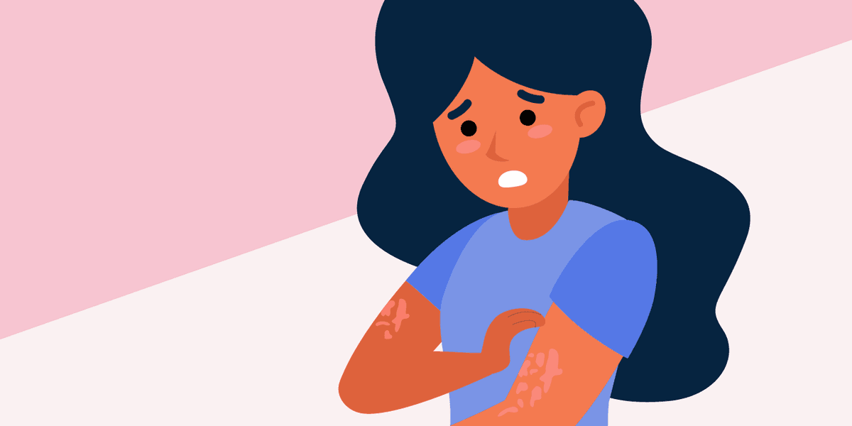 Information About Persistent Spontaneous Urticaria