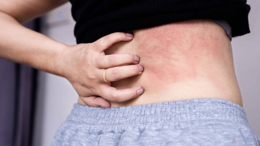 Dwelling with Persistent Spontaneous Urticaria