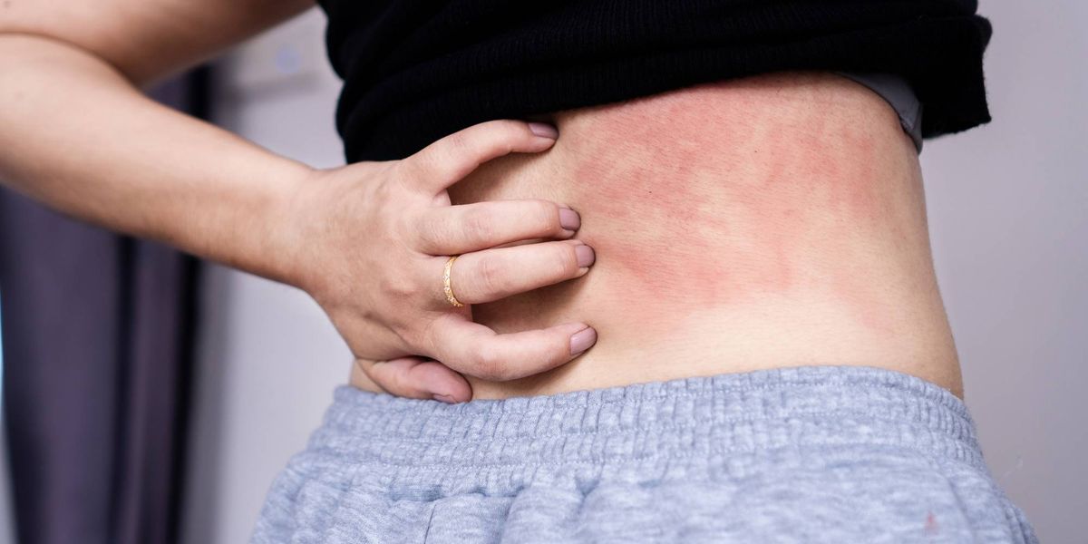 Dwelling with Persistent Spontaneous Urticaria