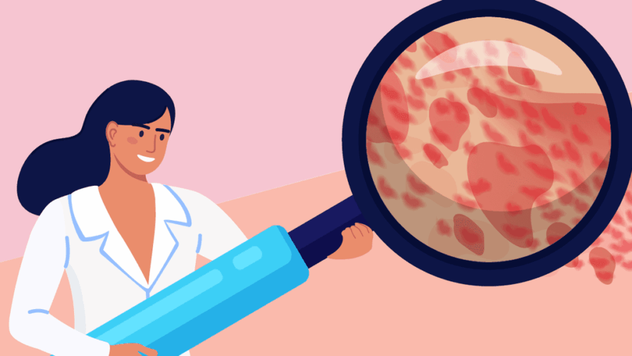 What Is Power Spontaneous Urticaria?