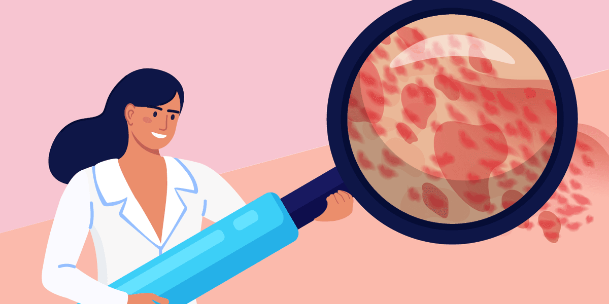 What Is Power Spontaneous Urticaria?