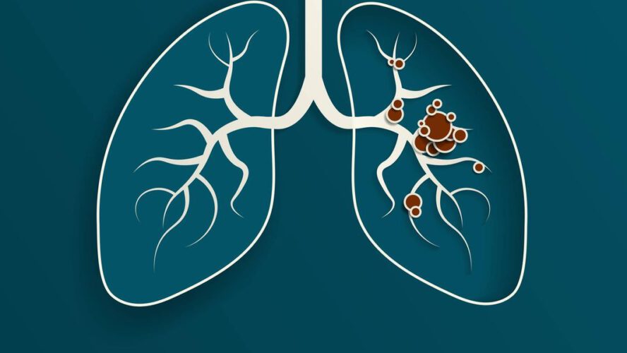 How Do Lung Most cancers Biomarkers Assist Information Therapy?